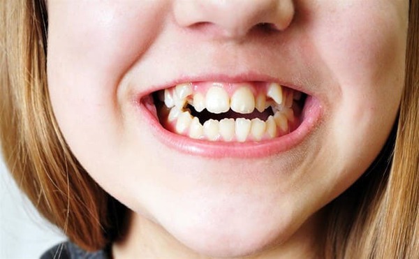 Răng khểnh là gì